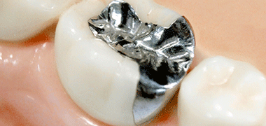 金属アレルギー