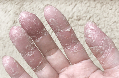 金属アレルギー